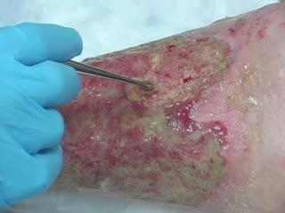 rinciples of Biofilm Based Wound Care 1.