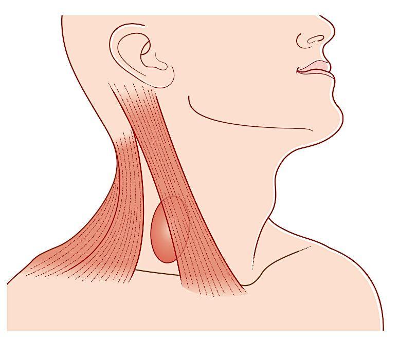 PHARYNGEAL POUCH CLINICAL FEATURES Dysphagia Regurgitation of undigested food Swelling behind the sternomastoid muscle at the level
