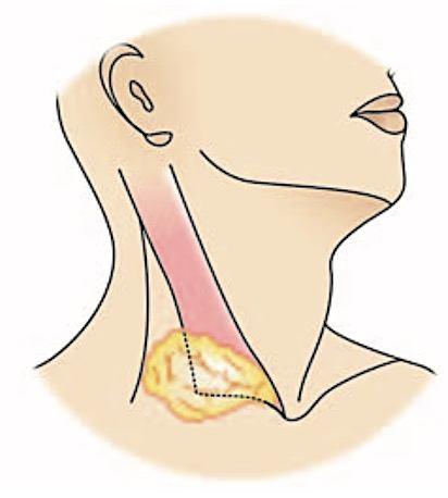 CYSTIC HYGROMA CLINICAL PRESENTATION Situated in lower part of posterior