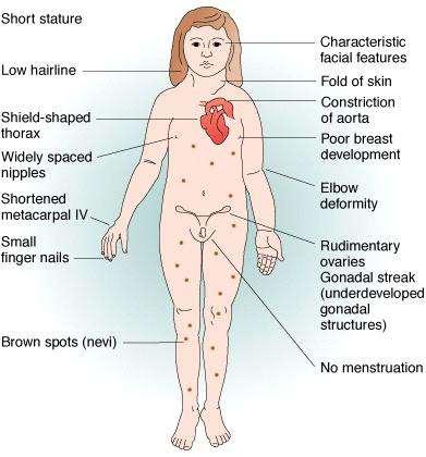 Topic: Turner syndrome Objective: Describe nondisjunction in Turner syndrome.