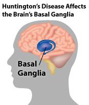 Huntington s disease Neurodegenerative disorder that cells in the basal ganglia, the