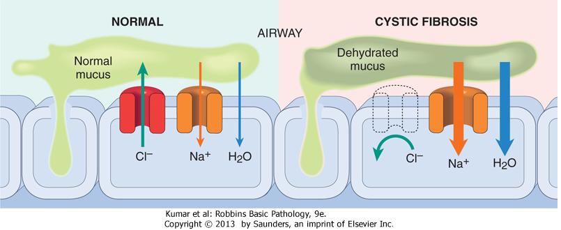 Cystic fibrosis Disease that affects the respiratory and digestive systems Mutation of CFTR gene encoding chloride channel essential for production of sweat, mucus, and digestive components