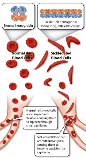 Sickle cell anemia A disorder that affects red blood cells Caused by a missense mutation of a single nucleotide in a gene encoding for beta subunit