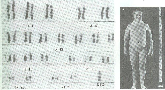 Sex Chromosome disorders In females, nondisjunction can lead to