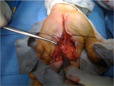 Fig. 4 Volar approach showing the damaged volar structures during surgical reduction of the complex open dislocation and IV metacarpal head fracture pinning Discussion The usual mechanism of injury