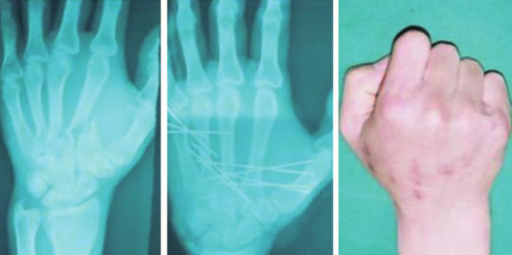 J Korean Soc Surg Hand Vol. 18, No. 3, September 2013 Fig. 1. Spiral metacarpal fracture with rotational malalignment.