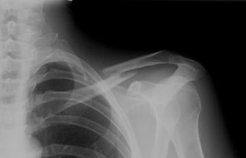 Clavicle Mid shaft Fx : Non-op except Open Fx NV