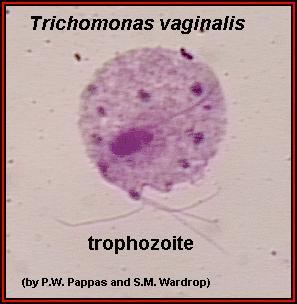 Trichomoniasis: KEY POINTS Caused by Trichomonas vaginalis,, flagellated anaerobic protozoa In women, causes malodorous yellow-grey discharge with