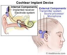 Cochlear Implant Device