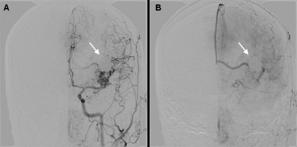 Images for this section: Fig. 0: DSA image of AVM-related false aneurysm (arrow) after coil embolization - arterial (A) and venous phase (B).