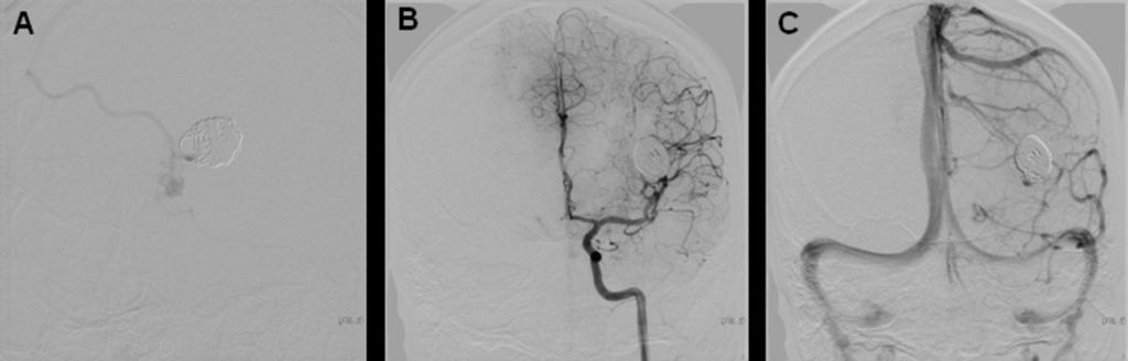 AVM in the left frontotemporal region after embolization of pseudoaneurysm.