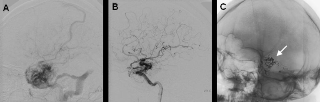 Images for this section: Fig. 0: AVM in the left temporal region before (A) and after embolization with Onyx (B) with 80% reduction of AVM volume.