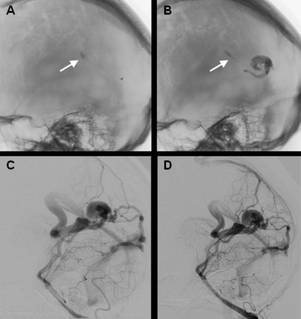 Images for this section: Fig. 0: Complication of AVM embolization with Onyx 34. Dislocation of embolization material into sinus rectus (arrow) (A, B).