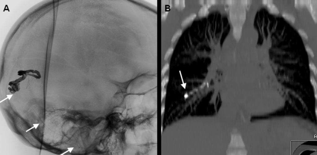 Images for this section: Fig. 0: Complication of AVM embolization with Onyx.