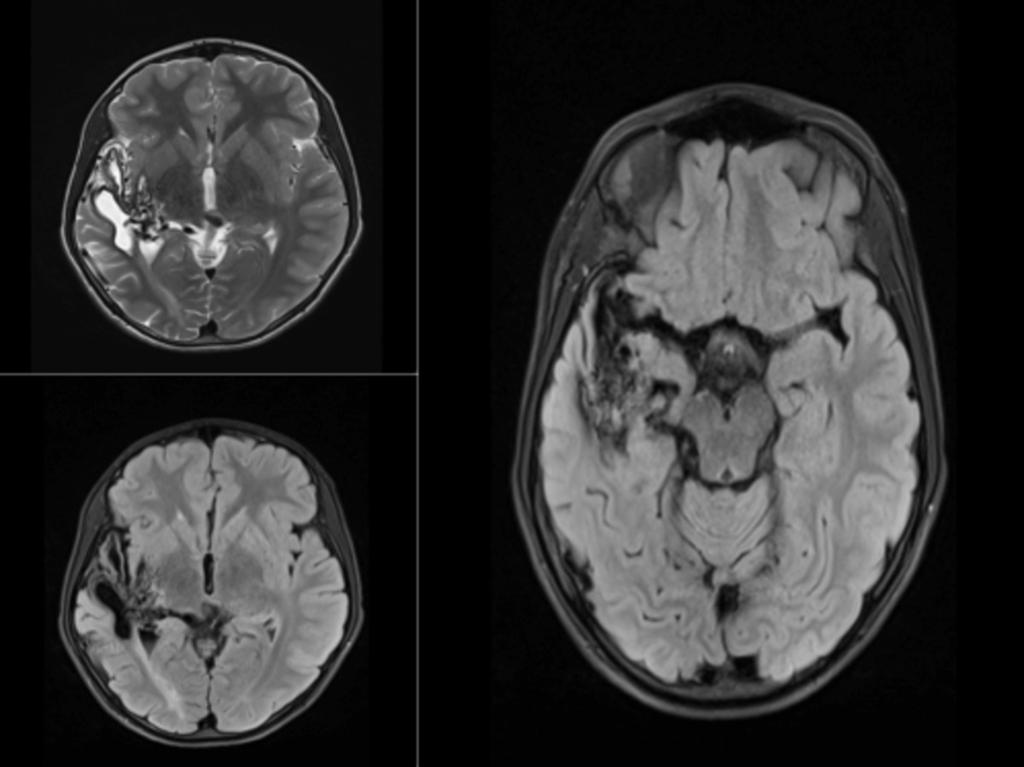 Fig. 10: A 9 year old patient presented a severe headache with no focal neurologic symptoms.
