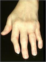 15 RA Here you see RA changes to the hand: think what it does to the rest of the body