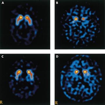 Differentiation of dementia with Lewy bodies from Alzheimer s disease 135 2β-carbomethoxy-3β-(4-iodophenyl)tropane (β-cit) to visualise the dopamine transporter.