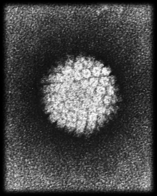 Human papilloma virus (HPV) in immunocompromised patients Rapid progression of HPV infection severe, persistent and extensive manifestations of HPV disease 1