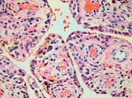 Figure 4 Histology slide: hemosiderin Stained macrophages Postoperative period was normal, applied physical therapy gave satisfactory result and was found to be pain free on day 14 of surgery, on
