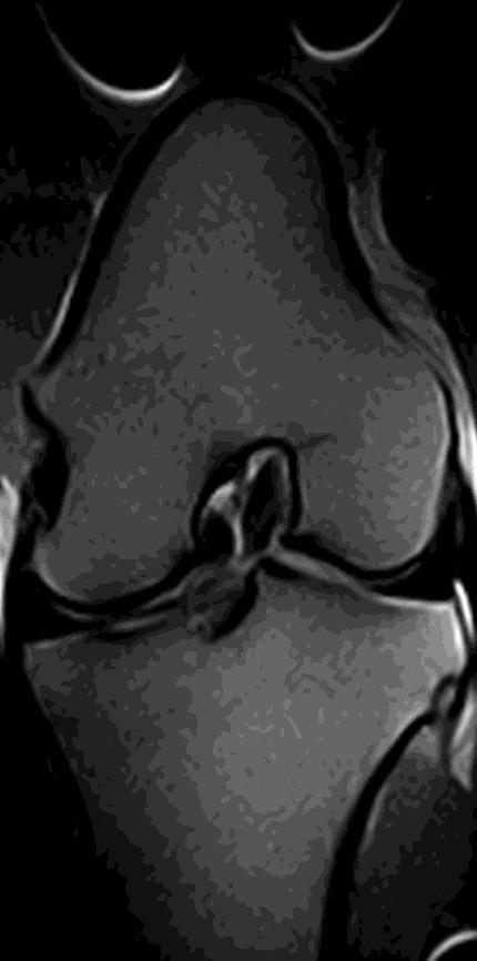 MRI Cartilage Defects T