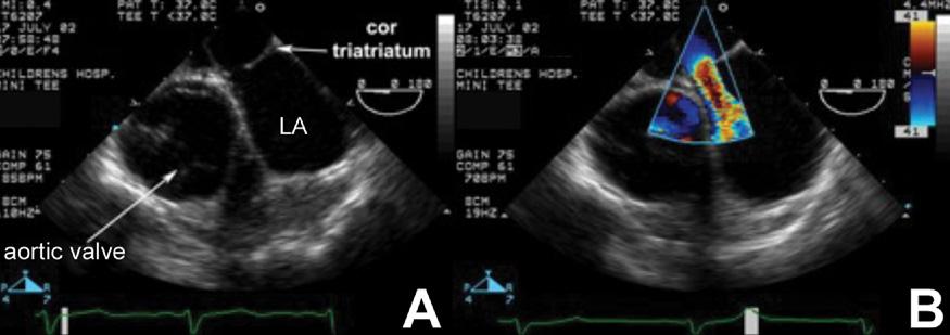 Echocardiogram from a four-chamber view demonstrating the presence of a complete atrioventricular septal defect (AVSD) with hypoplasia of the right ventricle (RV).