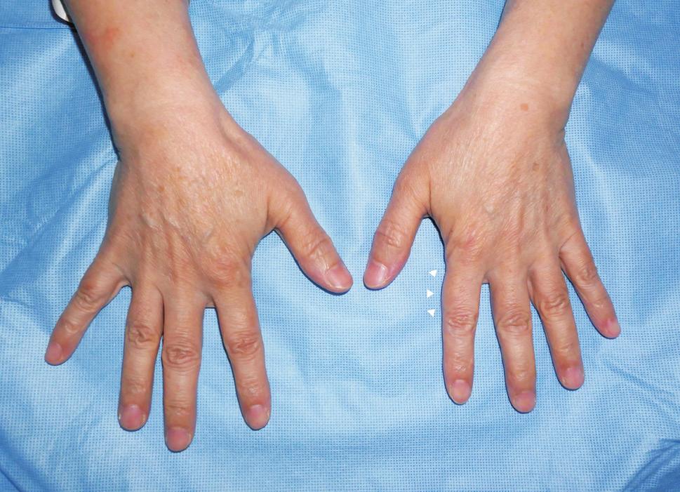 Archives of Hand and Microsurgery Vol. 23, No. 4, December 2018 decompression. CASE REPORT A 62-year-old female presented with severe pain on radial side of the right index finger.