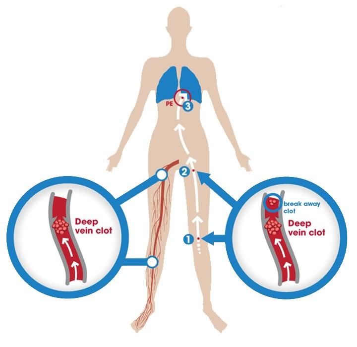 Venous Thromboembolism (VTE)? VTE is a blood clot that forms in the veins of the body. The most common vein blood clots are: 1.