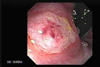 Upper Gastrointestinal hemorrhage Dieulafoy s Leasin are vascular malformationes found