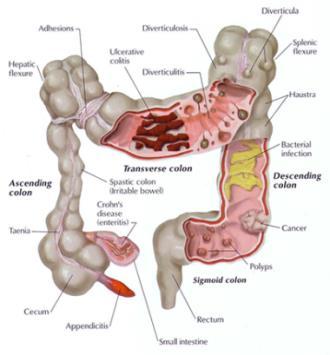 Lower intestinal hemorrhage Lower
