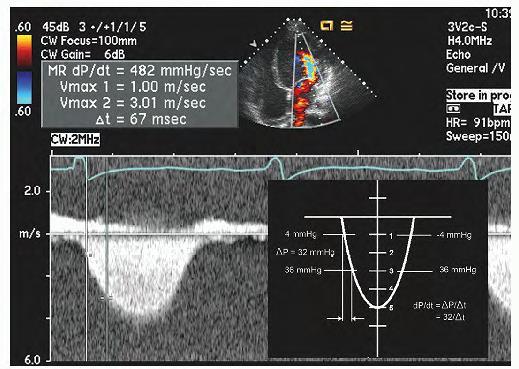 Adel Hasanin Ahmed 6 4. Rate of ventricular pressure rise (dp/dt)- can be estimated by using time interval between 1 and 3m/sec on MR velocity CW spectrum during IVCT i.e. in early phase of systole before AV opens when there is no significant change in LA pressure.