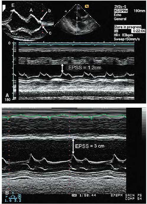 Adel Hasanin Ahmed 7 6. Annular systolic velocity- is a marker of longitudinal LV function (and global LV function in a uniformly contracting ventricle). Normal average of septal and lateral Ś > 7.