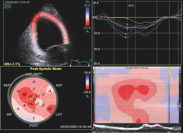 using endocardial, midwall, or average deformation Most of data come from mid-wall GLS, which is reproducible and robust In a healthy person, a peak GLS around 20% can be expected, and the lower the