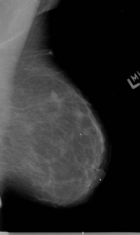 Methods- Dataset Digital Database for Screening Mammography*: 3034 2D mammography images (2620 patients) 4 USA Hospitals (MGH, Wake Forest, Sacred Heart, WUSTL) Normal & Benign or malignant masses