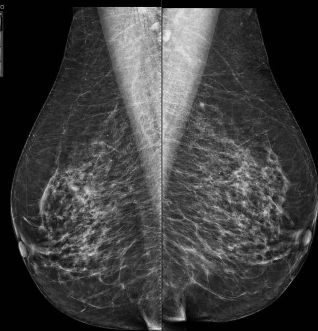 Mammography as a Model? Mammography is recommended annually for all women over age 40 by the ACR.