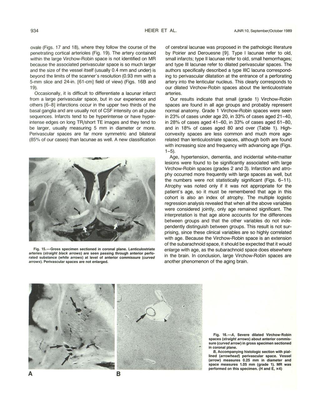 934 HEIER ET AL. AJNR :1 0, September/Otober 1989 ovale (Figs. 17 and 18), where they follow the ourse of the penetrating ortial arterioles (Fig. 19).