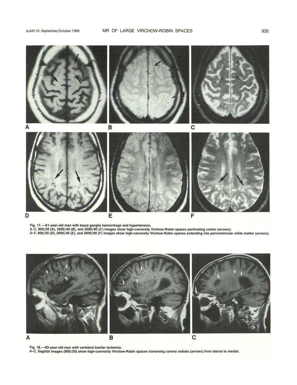 AJNR:1 0, September/Otober 1989 MR OF LARGE VIRCHOW-ROBIN SPACES 935 B Fig. 17.-61-year-old man with basal ganglia hemorrhage and hypertension.