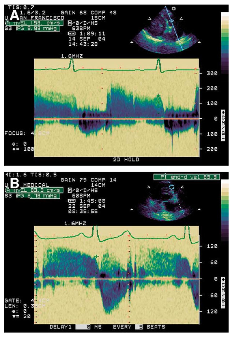 Ristow et al. Page 9 Figure 2. Case illustrates elevated end-diastolic pulmonary regurgitation (EDPR) gradient of 10 mm Hg before treatment for heart failure (A) and improvement 2 weeks later to 2.