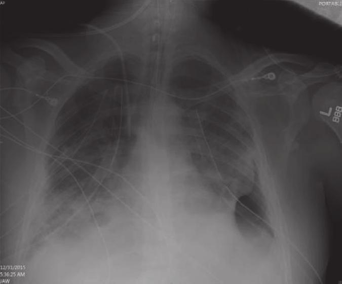 2 Case Reports in Critical Care (a) Figure 1: The left chest roenterogram represent pre-ebv placement. The right chest roenterogram represents post-ebv placement.