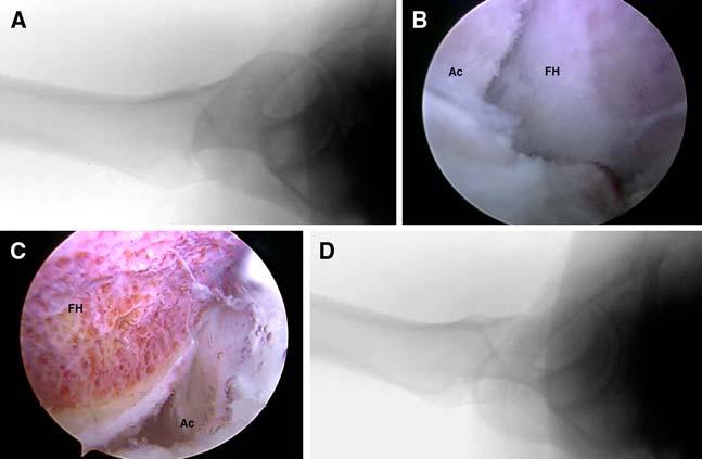 Knee Surg Sports Traumatol Arthrosc (2007) 15:908 914 911 5 underwent thermal chondroplasty, and 2 patients had no treatment due to the diffuseness of their disease.