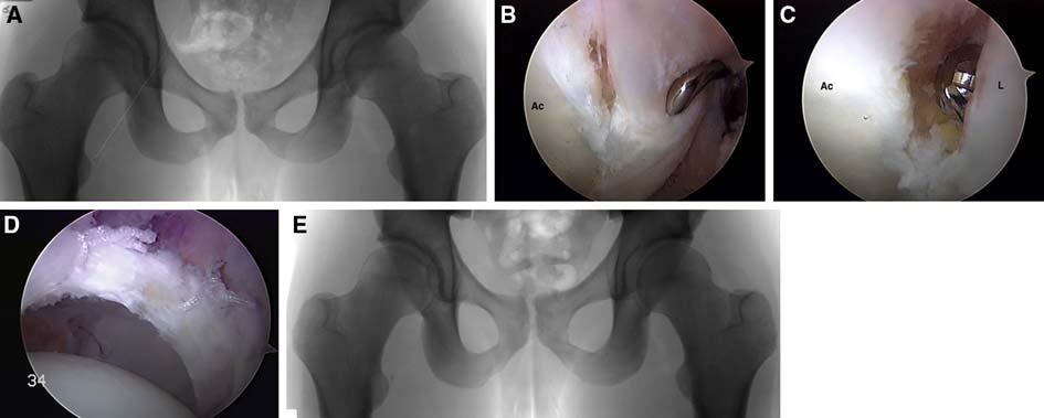 912 Knee Surg Sports Traumatol Arthrosc (2007) 15:908 914 Fig. 2 A 22-year-old professional football player was evaluated for right hip pain.
