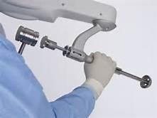 of bone Real-time evaluation Computer Assisted Hip Replacement Makoplasty Technique: Allows single stage reaming Solid, stable fit of the acetabular component