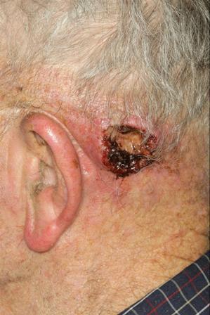 92 yo male with SCC on