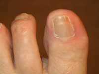 There are two common minor surgical procedures that can be carried out to toenails depending on which problem you have. Both procedures will involve a local anaesthetic.