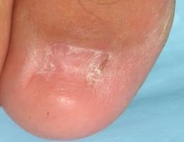 Thickened fungal nail - before surgery Toenail after total nail avulsion Following an assessment within the podiatry department we will determine if you will benefit from either a partial or total
