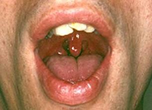 Pharyngeal Gonorrhea Pharyngeal Gonorrhea Symptoms: