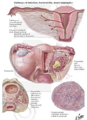 Complications of Untreated genital infections result of spread of pathogen, inflammatory response and subsequent healing (scarring) Pelvic inflammatory disease / epididymitis