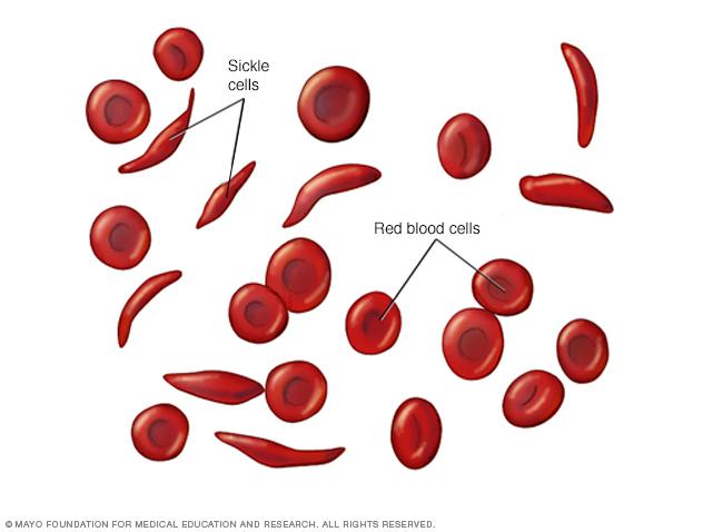 Disorders Involving Red Blood Anemia Iron-deficiency anemia pernicious