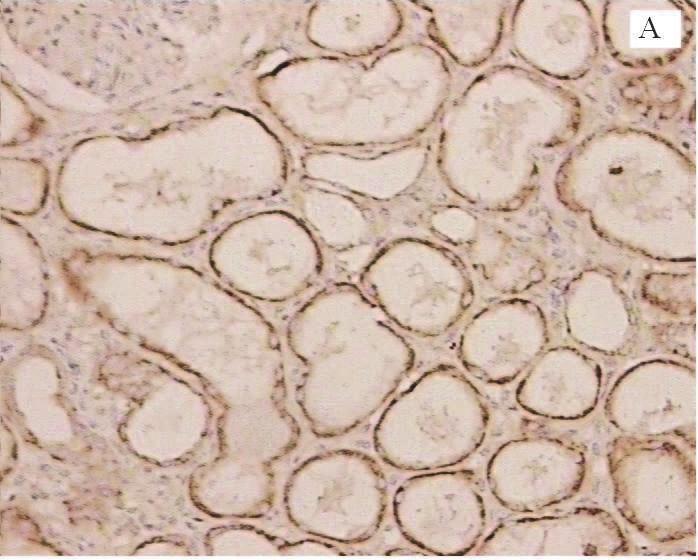 Antibody-Mediated Kidney Allograft Rejection 329 Fig. 3. Representative examples of immunohistochemical staining of BAFF and C4d in renal allograft rejection (original mannification 200X).