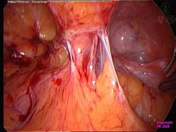 May cause pain due to organ distension or stretching Usually caused by surgery, endometriosis, inflammation, or infection On diagnostic laparoscopy adhesions are found in 25% to 50% of CPP but their