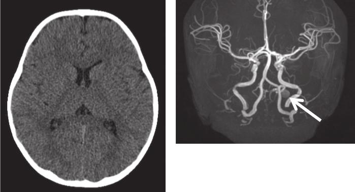 K. Hatayama et al. Pial AVF in a child with hemiplegia extending to the C2-C3 level (Fig. 2). He was admitted to the Intensive Care Unit (ICU) and was put on a ventilator for artificial ventilation.